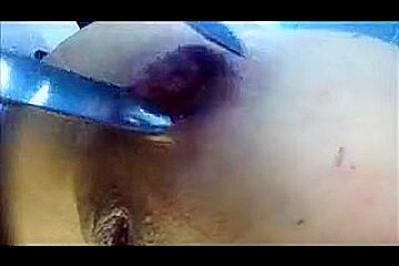 Amateur buttplug self fisting prolapse